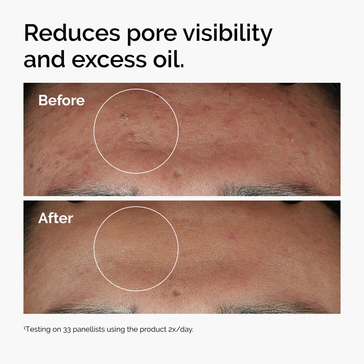 niacinamide-10-zinc-1-v9 ord-niacinamide-zinc-blemish-serum-before-after-pores.jpg