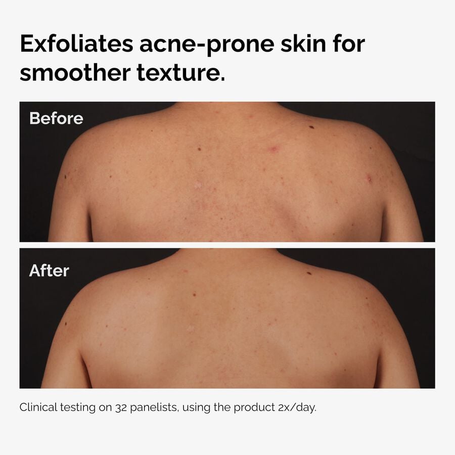 the-body-care-collection-s3 ord-salicylic-acid-body-serum-before-after-graphic-NA.jpg