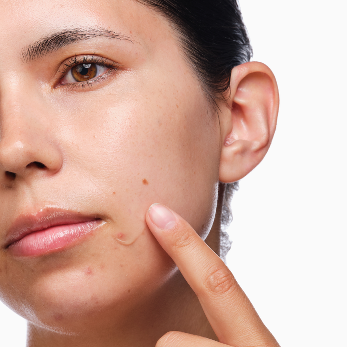 the-acne-set-g1 rdn-the-acne-set-application.png